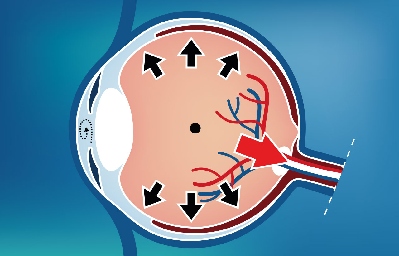 Glaukom (Grüner Star) Ursache