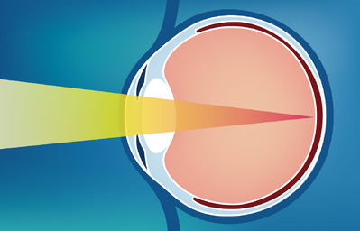 Fehlsichtigkeiten des Auges